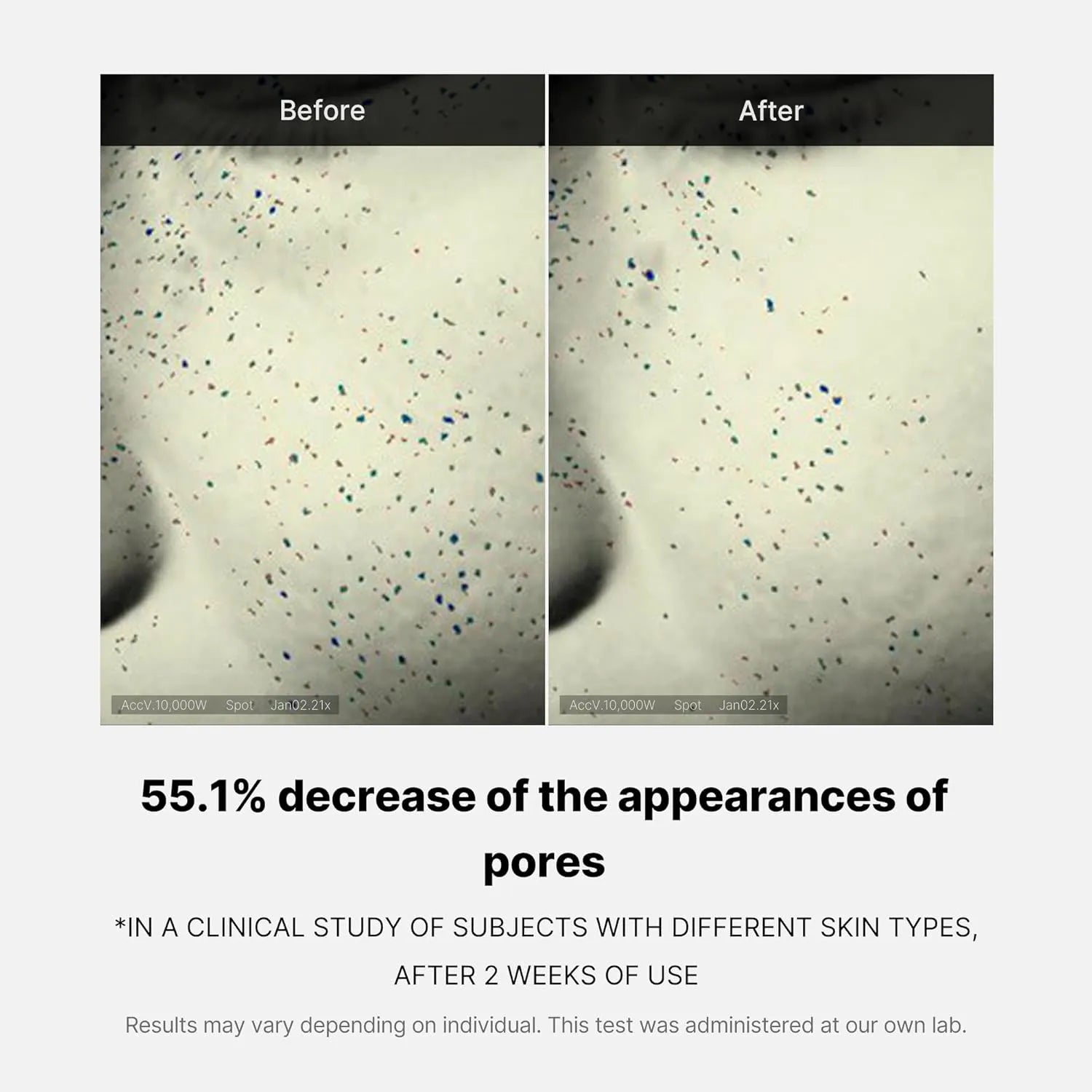 Before and after results showing reduced pore appearance using Medicube Zero Pore One-Day Cream
